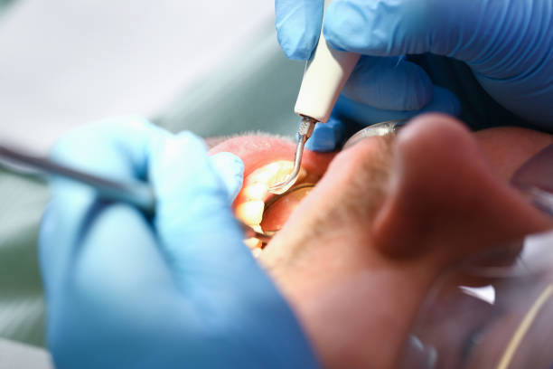 Best Emergency Root Canal Treatment in Lewisville, WA