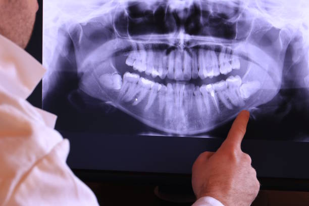 Best Emergency Dentist for Lost Fillings or Crowns in Lewisville, WA